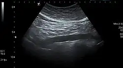 Abdominal aorta ultrasound