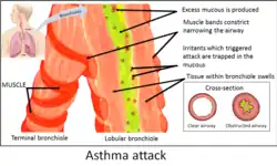 A diagram of the airways of a person with asthma.