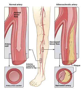 Illustration of atherosclerosis causing arterial obstruction which clinically presents at peripheral artery disease.