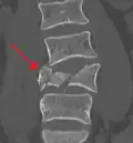 A burst fracture of L4 as seen on CT