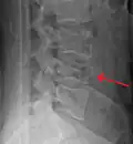 A burst fracture of L4 as seen one plane X ray