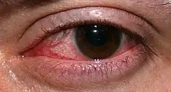Closeup of an eye infection after wearing contact lenses