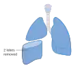 Removal of two lobes of the lung