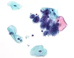 Micrograph of a Pap test showing changes of herpes simplex virus. Pap stain.