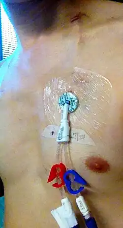 Photograph of an inserted Hickman line, which is a type of tunneled catheter, inserted in the chest.