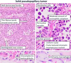 Histopathology of solid pseudopapillary tumor[9]