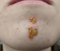Impetigo