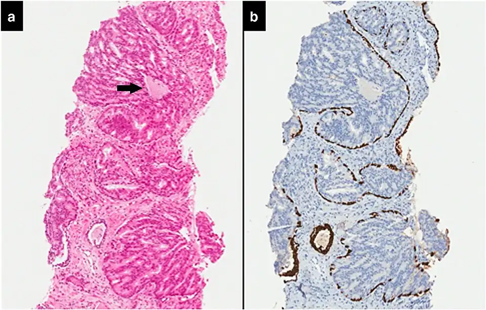 Intraductal carcinoma of the prostate with an infiltrative growth pattern may be morphologically difficult to distinguish from invasive cancer. One focus shows comedonecrosis (arrow), morphologically suggesting Gleason pattern 5 invasive carcinoma (a haematoxylin and eosin, b CK5/6)[20]