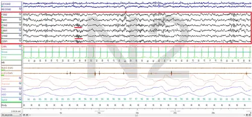 Stage N2 Sleep. EEG highlighted by red box. Sleep spindles highlighted by red line.