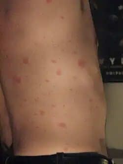 Multiple, red, well demarcated papules and plaques on the flank of an adult male