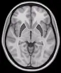 Horizontal slice of MRI-image showing the putamen. The other nuclei of the basal ganglia (caudate nucleus and globus pallidus) can be seen as well.