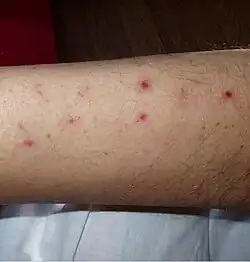 Numerous spots of bleeding into the skin of the leg in a person infected with T. b. rhodesiense[15]