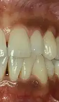 Smoker's melanosis in upper and lower gums