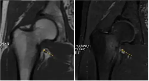 Furthermore, T1 (left) and DP fat saturated (right) weighted MR images showed the fracture line and a pattern of edema.[1]