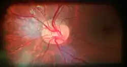 Tilted optic disc in left eye of a 20-year-old male.