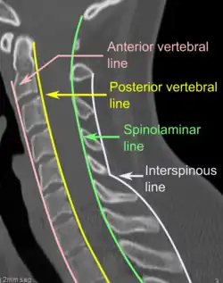 CT scan of normal congruous vertebral lines[7]