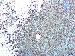 A color photomicrograph, demonstrating macrophages and giant cells in a case of xanthogranulomatous pyelonephritis.