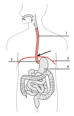 Спонтанный разрыв пищевода20 апреля 2013