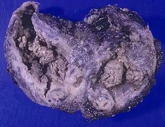 Аспергиллома, сопровождаемая туберкулёзом лёгких