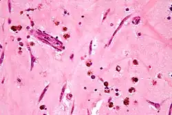 Синдром Карнея