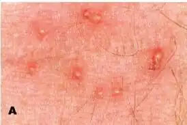 Укусы клеща Pyemotes herfsi