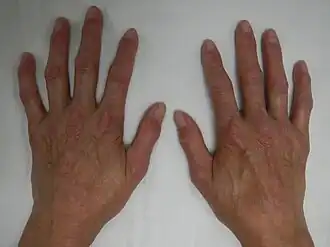 CREST-синдром (кальциноз и склеродактилия)