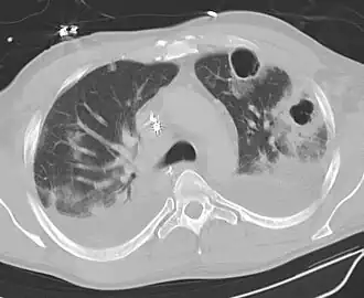 Картина абсцесса лёгкого при компьютерной томографии. Видна полость в ткани лёгкого.