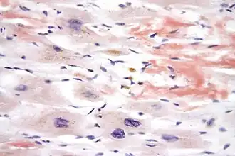 Микрофотография, демонстрирующая амилоидоз сердца, причину рестриктивной кардиомиопатии. Окраска конго красным.