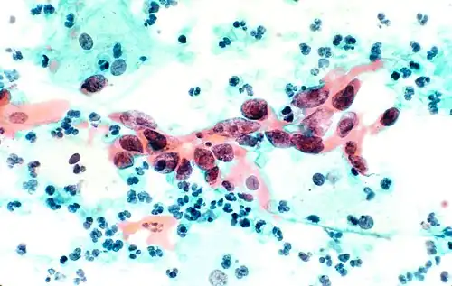 Плоскоклеточная карцинома шейки матки.