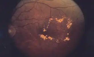 Макулярный отёк