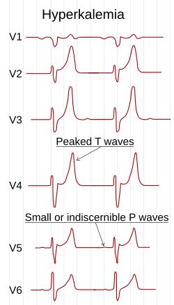 Электрокардиограмма, которая показывает изменения в грудных отводах  при гиперкалиемии