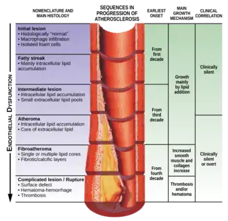 Изменения в сосуде (процесс развития атеросклероза),  накапливание холестерина