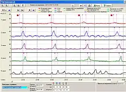 Манометрия пищевода. Показано прохождение глотка воды
