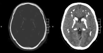 Идиопатическая кальцификация базальных ганглиев
