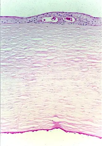 Изменение структуры десцеметовой мембраны, кисты в эпителии, эктопия его базальной мембраны.