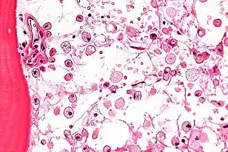 Лизосомные болезни накопления19 января 2015