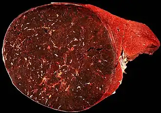 Гамартома селезёнки