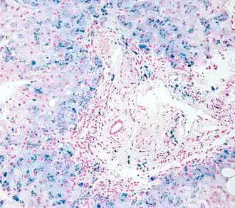 Биопсия: гистологическая картина гемосидероза.
