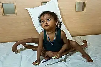 Лакшми перед 27-часовой операцией в 2007 году