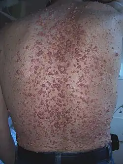 Нейрофиброматоз I типа6 июня 2011