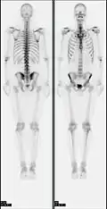 Сканирование костей всего тела с помощью ядерной медицины. Сканирование костей всего тела в ядерной медицине обычно используется для оценки различных патологий, связанных с костями, таких как боли в костях, стрессовые переломы, доброкачественные поражения костей, инфекции костей или распространение рака на кость.