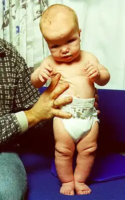 Церебральный гигантизм.