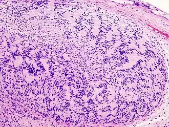 Микропрепарат опухоли окраска гематоксилин-эозин.