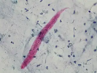 Филяриевидная личинка при стронгилоидозе в препарате бронхоальвеолярного лаважа.