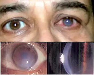 Пеллюцидная краевая дегенерация роговицы. Водянка роговицы и отслоение десцеметовой мембраны